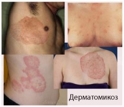 Спрей от дерматомикоза Sakaedano Pharmaceutical (Япония) / арт. 279-131